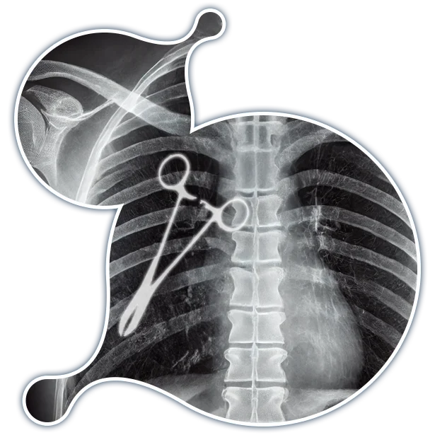 Instrument left in the lungs after operations - Examining Board QA QI Technology Integration Instrument left in the lungs after operations - Examining Board QA QI Technology Integration